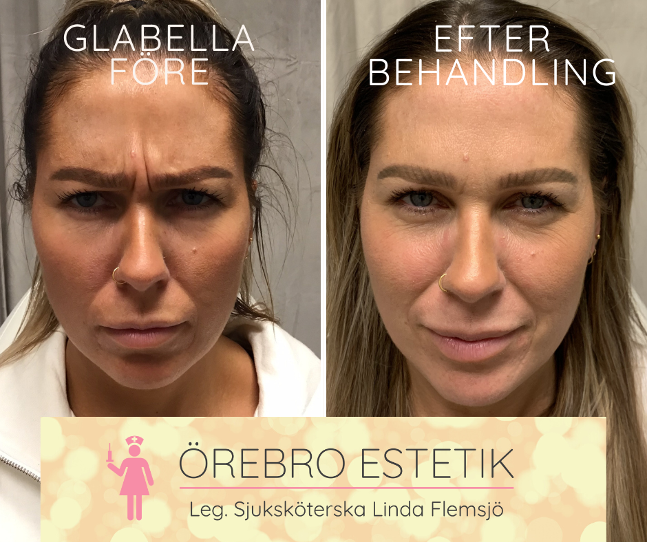 Botox Glabella Örebro