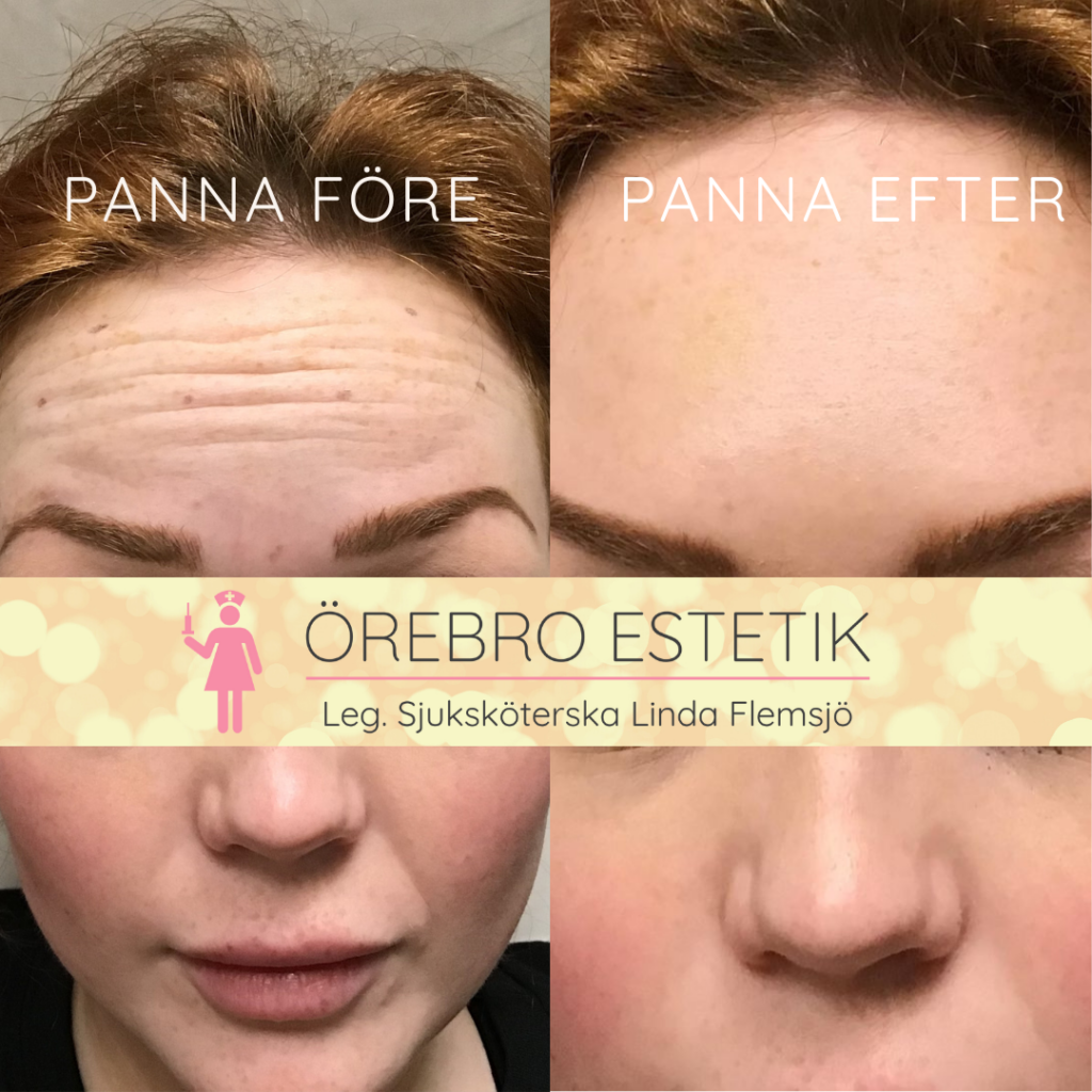 Botox Panna Örebro Estetik