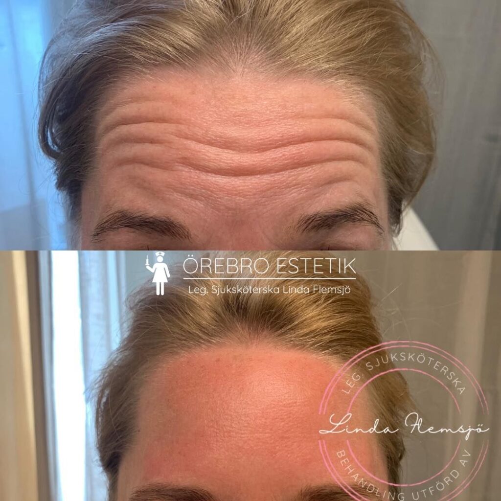 Botox Örebro Estetik